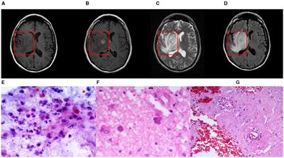 Lesion region inpainting: an approach for pseudo-healthy image synthesis in intracranial infection imaging